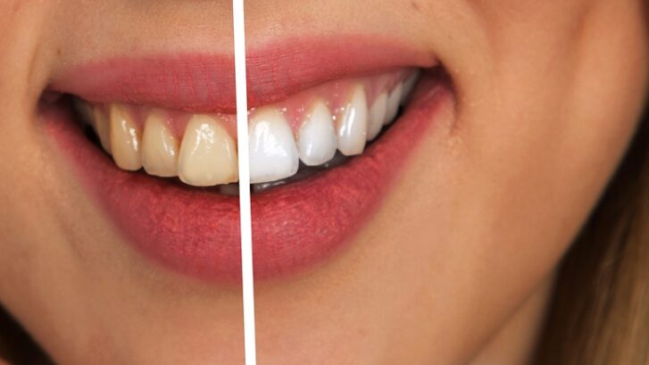 Pro White Teeth Whitening Kits